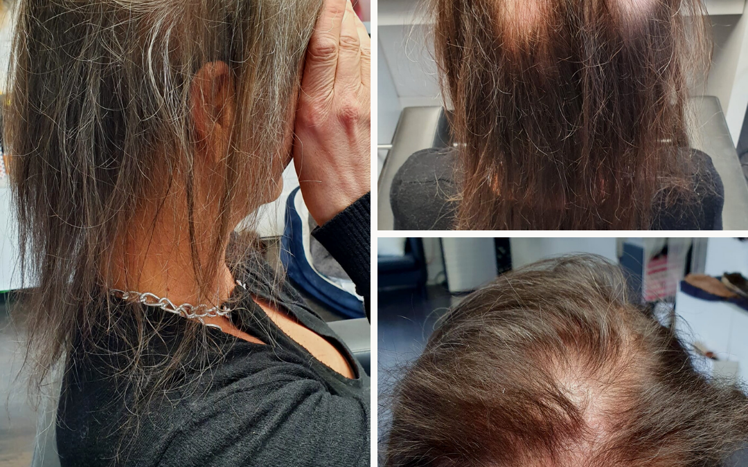 Erblich bedingter Haarausfall (Alopezie) – was ist das und was kann ich tun
